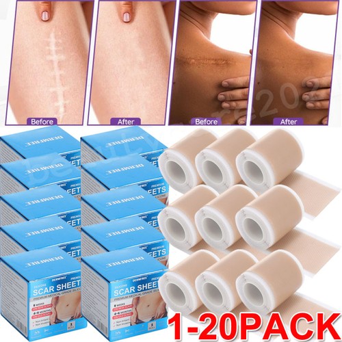 20x silicone scar sheet - silicone,